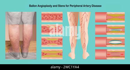 Abbildung: Angioplastie bei peripherer arterieller Verschlusskrankheit. Begriff der trockenen Haut, alter Senioren, Krampfadern und TVT. Stockfoto