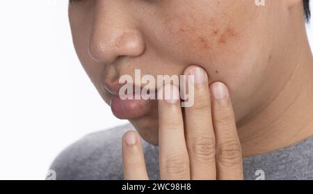 Junger Mann sorgt sich um dunkle Flecken und Melasma im Gesicht. Stockfoto