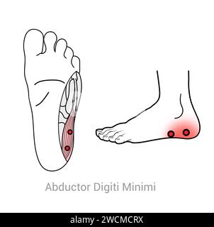 Abductor digiti Minimi: Myofasziale Triggerpunkte und assoziierte Schmerzorte Stockfoto