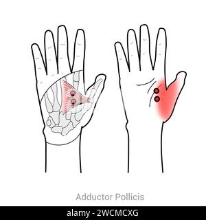 Adductor pollicis: Myofasziale Triggerpunkte und damit verbundene Schmerzorte Stockfoto