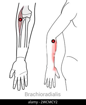 Brachioradialis: Myofasziale Triggerpunkte und assoziierte Schmerzorte Stockfoto