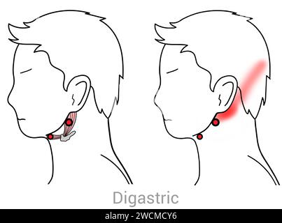 Digastric: Myofasziale Triggerpunkte und assoziierte Schmerzorte Stockfoto