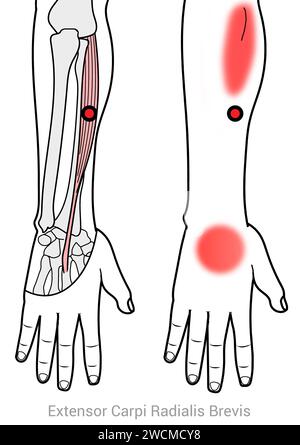 Extensor Carpi radialis Brevis: Myofasziale Triggerpunkte und assoziierte Schmerzorte Stockfoto