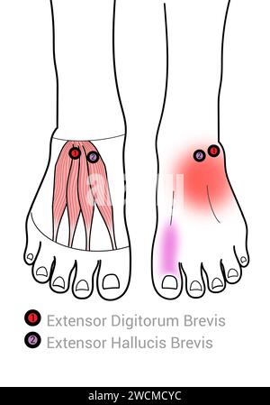 Extensor digitorum Brevis: Myofasziale Triggerpunkte und assoziierte Schmerzorte Stockfoto