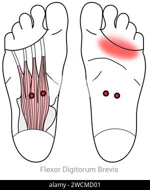 Flexor digitorum Brevis: Myofasziale Triggerpunkte und assoziierte Schmerzorte Stockfoto