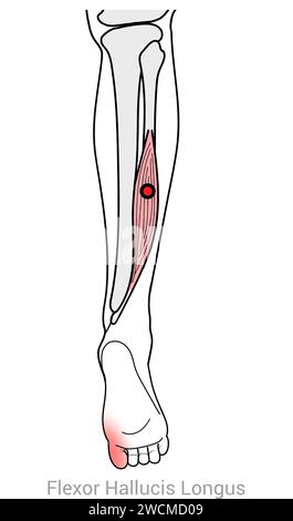 Flexor hallucis Longus: Myofasziale Triggerpunkte und assoziierte Schmerzorte Stockfoto