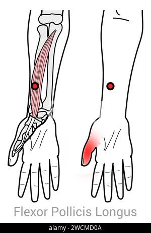 Flexor pollicis Longus: Myofasziale Triggerpunkte und assoziierte Schmerzorte Stockfoto