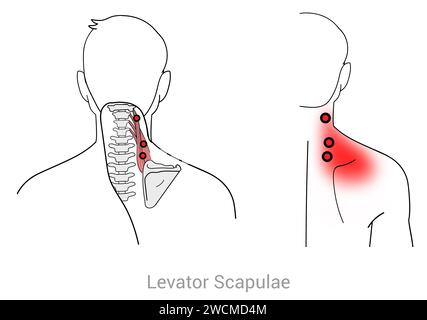 Levator scapulae: Myofasziale Triggerpunkte und assoziierte Schmerzorte Stockfoto