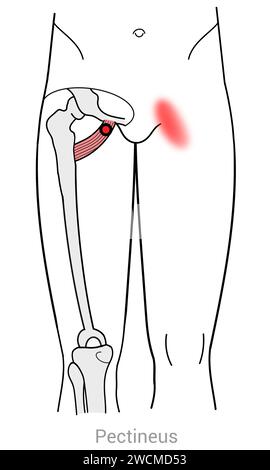 Pectineus: Myofasziale Triggerpunkte und assoziierte Schmerzorte Stockfoto