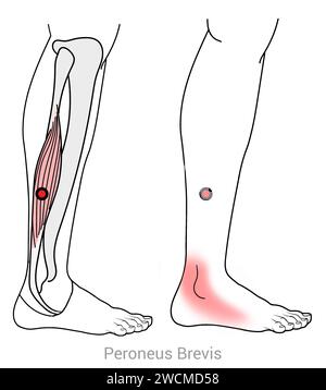 Peroneus Brevis: Myofasziale Triggerpunkte und assoziierte Schmerzorte Stockfoto