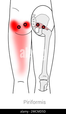 Piriforis: Myofasziale Triggerpunkte und assoziierte Schmerzorte Stockfoto