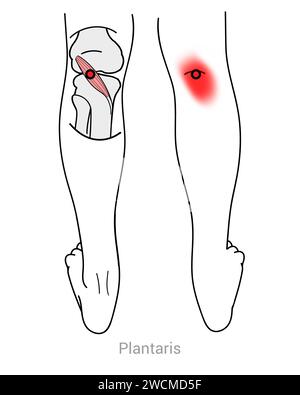 Plantaris: Myofasziale Triggerpunkte und assoziierte Schmerzstellen Stockfoto