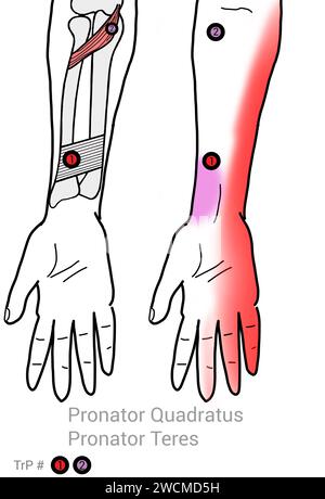 Pronator Quadratus und Pronator Teres: Myofasziale Triggerpunkte und assoziierte Schmerzorte Stockfoto