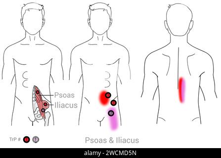 Psoas und Iliacus: Myofasziale Triggerpunkte und assoziierte Schmerzorte Stockfoto