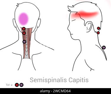 Semispinalis capitis: Myofasziale Triggerpunkte und assoziierte Schmerzorte Stockfoto