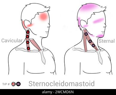 Sternocleidomastoid: Myofasziale Triggerpunkte und damit verbundene Schmerzorte Stockfoto