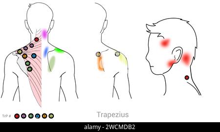 Trapezius: Myofasziale Triggerpunkte und damit verbundene Schmerzstellen Stockfoto