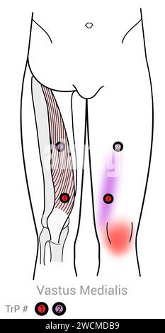 Vastus medialis: Myofasziale Triggerpunkte und assoziierte Schmerzorte Stockfoto