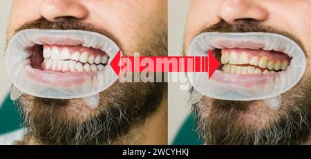 Lächeln Sie vor und nach dem Bleichen. Zahnpflege und Zahnaufhellung. Ergebnis der Zahnaufhellung. Zahnaufhellung Vor Nachher. Yollow oder weiße Zähne. Stockfoto