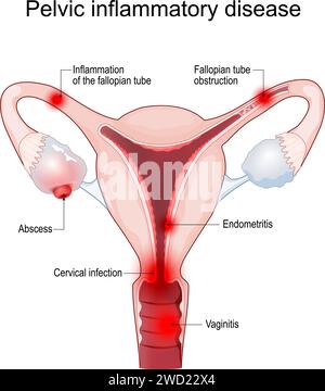 Beckenentzündungserkrankungen. Querschnitt einer Gebärmutter mit Symptomen der Entzündung, Eileiterverschluss, Endometritis, Salpingitis, Tubo-ovar Stock Vektor