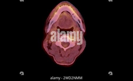 Ein PET-CT-Scan-Bild ist eine diagnostische Visualisierung, die Positronen-Emissions-Tomographie (PET) und Computertomographie (CT) kombiniert, um eine bessere Erkennung zu ermöglichen Stockfoto