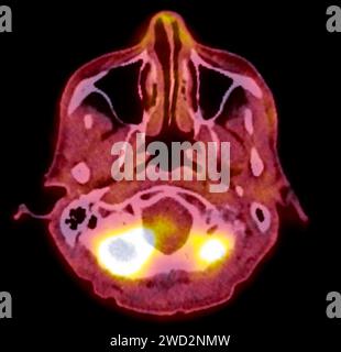 Ein PET-CT-Scan-Bild ist eine diagnostische Visualisierung, die Positronen-Emissions-Tomographie (PET) und Computertomographie (CT) kombiniert, um eine bessere Erkennung zu ermöglichen Stockfoto