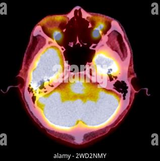 Ein PET-CT-Scan-Bild ist eine diagnostische Visualisierung, die Positronen-Emissions-Tomographie (PET) und Computertomographie (CT) kombiniert, um eine bessere Erkennung zu ermöglichen Stockfoto