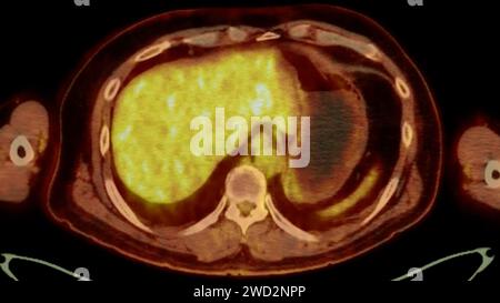 Ein PET-CT-Scan-Bild ist eine diagnostische Visualisierung, die Positronen-Emissions-Tomographie (PET) und Computertomographie (CT) kombiniert, um eine bessere Erkennung zu ermöglichen Stockfoto