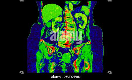 CT-Scan der Abdomen-koronalen Ansicht mit Injektionskontrastmittel mit grüner Farbmodus-koronaler Ansicht zur Diagnose abdominaler Erkrankungen. Stockfoto