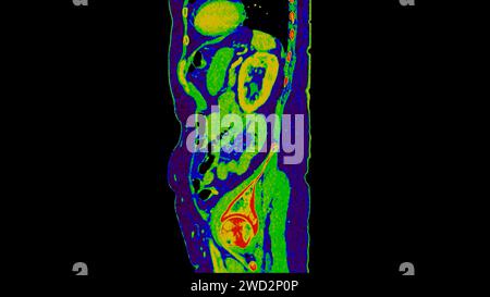 CT-Scan der sagittalen Abdomen-Ansicht mit Injektionskontrastmittel mit grüner Farbmodus-koronaler Ansicht zur Diagnose abdominaler Erkrankungen. Stockfoto