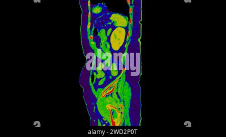 CT-Scan der sagittalen Abdomen-Ansicht mit Injektionskontrastmittel mit grüner Farbmodus-koronaler Ansicht zur Diagnose abdominaler Erkrankungen. Stockfoto