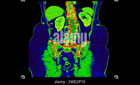 CT-Scan der Abdomen-koronalen Ansicht mit Injektionskontrastmittel mit grüner Farbmodus-koronaler Ansicht zur Diagnose abdominaler Erkrankungen. Stockfoto