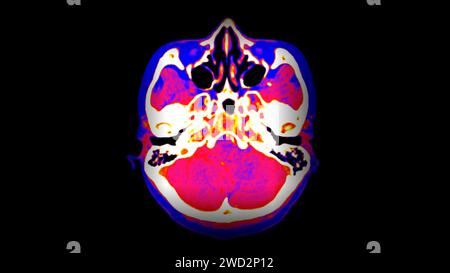 CT-Hirnperfusion oder CT-Scan der axialen Hirnansicht. Stockfoto