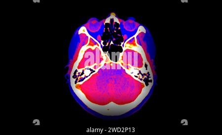 CT-Hirnperfusion oder CT-Scan der axialen Hirnansicht. Stockfoto