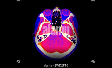 CT-Hirnperfusion oder CT-Scan der axialen Hirnansicht. Stockfoto