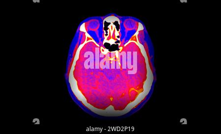 CT-Hirnperfusion oder CT-Scan der axialen Hirnansicht. Stockfoto