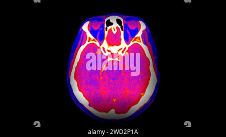 CT-Hirnperfusion oder CT-Scan der axialen Hirnansicht. Stockfoto