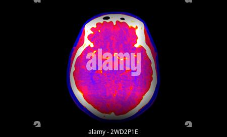 CT-Hirnperfusion oder CT-Scan der axialen Hirnansicht. Stockfoto