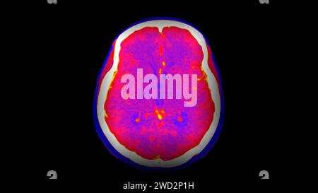 CT-Hirnperfusion oder CT-Scan der axialen Hirnansicht. Stockfoto