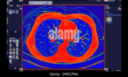 CT-Scan der Thoraxansicht im Farbmodus für diagnostische Lungenembolie (PE), Lungenkrebs und covid-19. Stockfoto