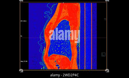 CT-Scan der sagittalen Thoraxansicht im Farbmodus für diagnostische Lungenembolie (PE), Lungenkrebs und covid-19. Stockfoto