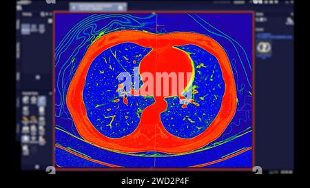 CT-Scan der Thoraxansicht im Farbmodus für diagnostische Lungenembolie (PE), Lungenkrebs und covid-19. Stockfoto