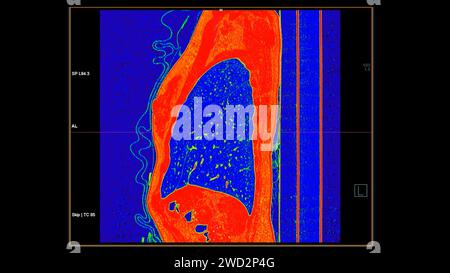 CT-Scan der sagittalen Thoraxansicht im Farbmodus für diagnostische Lungenembolie (PE), Lungenkrebs und covid-19. Stockfoto