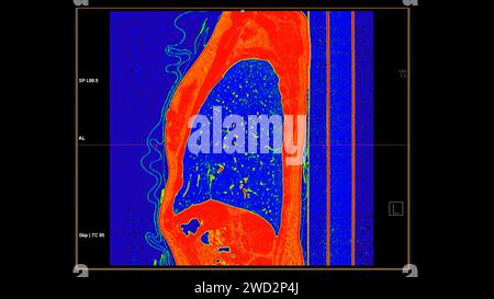 CT-Scan der sagittalen Thoraxansicht im Farbmodus für diagnostische Lungenembolie (PE), Lungenkrebs und covid-19. Stockfoto