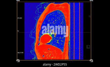 CT-Scan der sagittalen Thoraxansicht im Farbmodus für diagnostische Lungenembolie (PE), Lungenkrebs und covid-19. Stockfoto