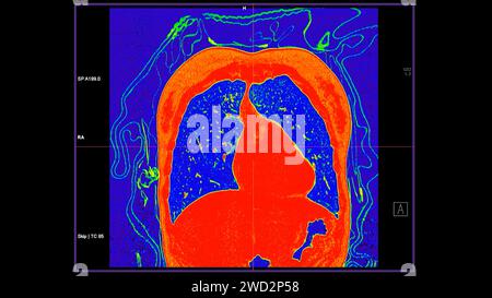 CT-Scan der koronalen Thoraxansicht im Farbmodus für diagnostische Lungenembolie (PE), Lungenkrebs und covid-19. Stockfoto