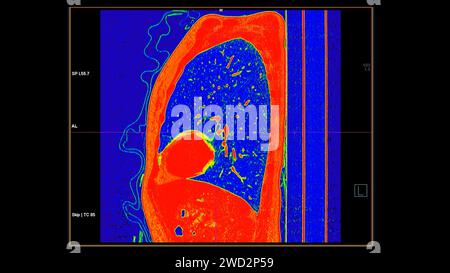 CT-Scan der sagittalen Thoraxansicht im Farbmodus für diagnostische Lungenembolie (PE), Lungenkrebs und covid-19. Stockfoto