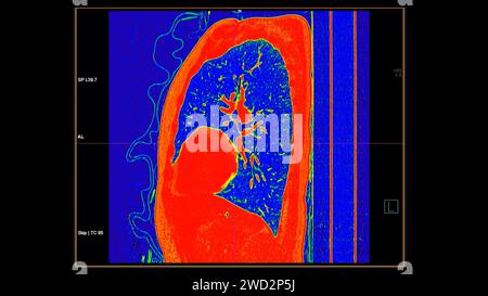 CT-Scan der sagittalen Thoraxansicht im Farbmodus für diagnostische Lungenembolie (PE), Lungenkrebs und covid-19. Stockfoto