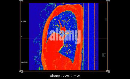 CT-Scan der sagittalen Thoraxansicht im Farbmodus für diagnostische Lungenembolie (PE), Lungenkrebs und covid-19. Stockfoto