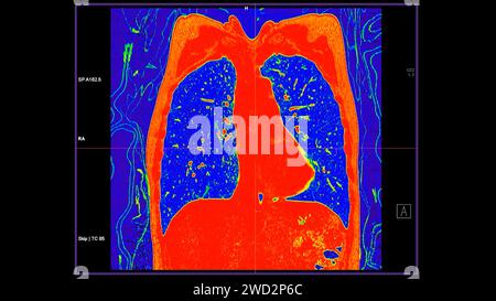 CT-Scan der koronalen Thoraxansicht im Farbmodus für diagnostische Lungenembolie (PE), Lungenkrebs und covid-19. Stockfoto